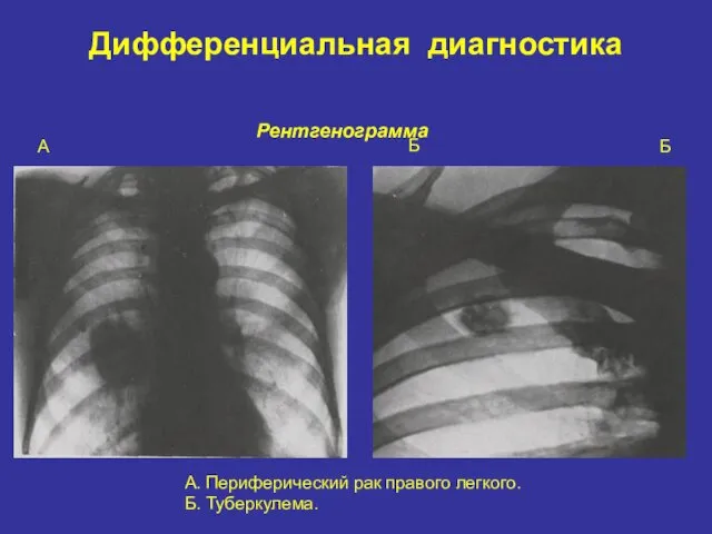 Дифференциальная диагностика А. Периферический рак правого легкого. Б. Туберкулема. А Б Рентгенограмма Б