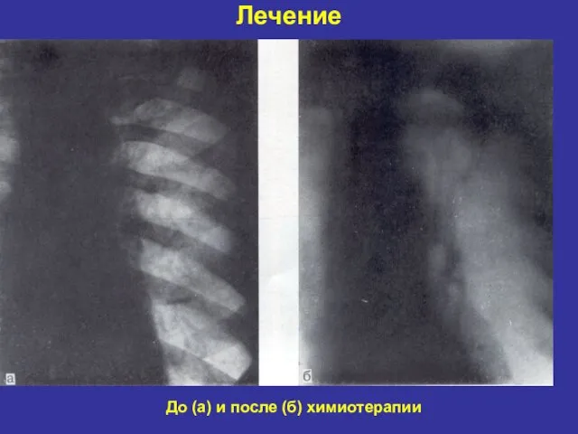 Лечение До (а) и после (б) химиотерапии