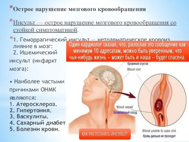 Острое нарушение мозгового кровообращения Инсульт — острое нарушение мозгового кровообращения со