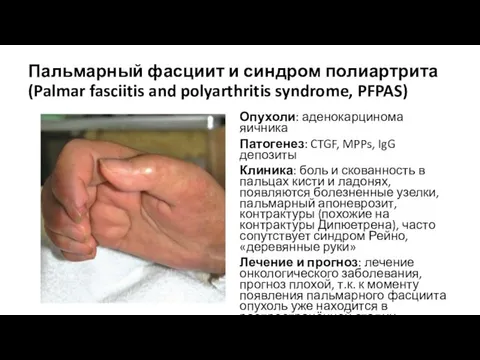 Пальмарный фасциит и синдром полиартрита (Palmar fasciitis and polyarthritis syndrome, PFPAS)