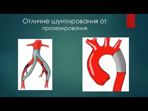 Отличие шунтирования от протезирования