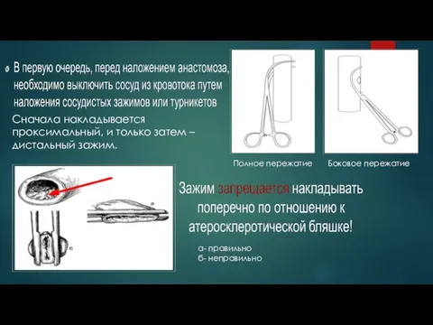 а- правильно б- неправильно Полное пережатие Боковое пережатие Сначала накладывается проксимальный,