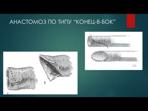 АНАСТОМОЗ ПО ТИПУ “КОНЕЦ-В-БОК”