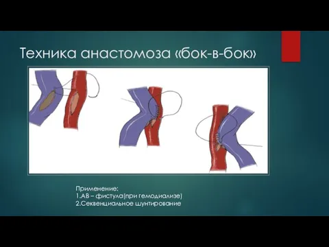 Техника анастомоза «бок-в-бок» Применение: 1.АВ – фистула(при гемодиализе) 2.Секвенциальное шунтирование