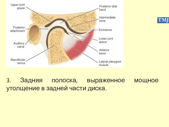 3. Задняя полоска, выраженное мощное утолщение в задней части диска.