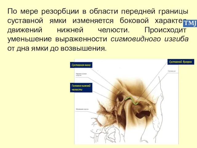 По мере резорбции в области передней границы суставной ямки изменяется боковой