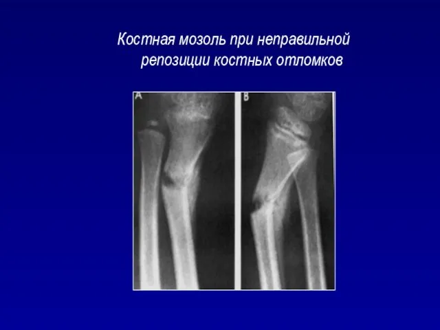 Костная мозоль при неправильной репозиции костных отломков