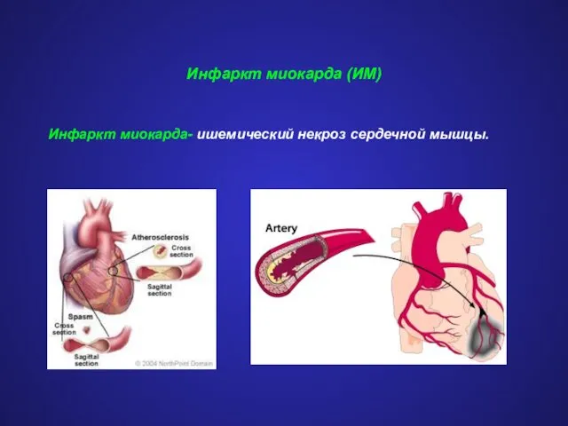 Инфаркт миокарда (ИМ) Инфаркт миокарда- ишемический некроз сердечной мышцы.