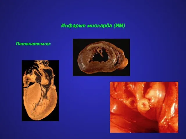 Инфаркт миокарда (ИМ) Патанатомия: