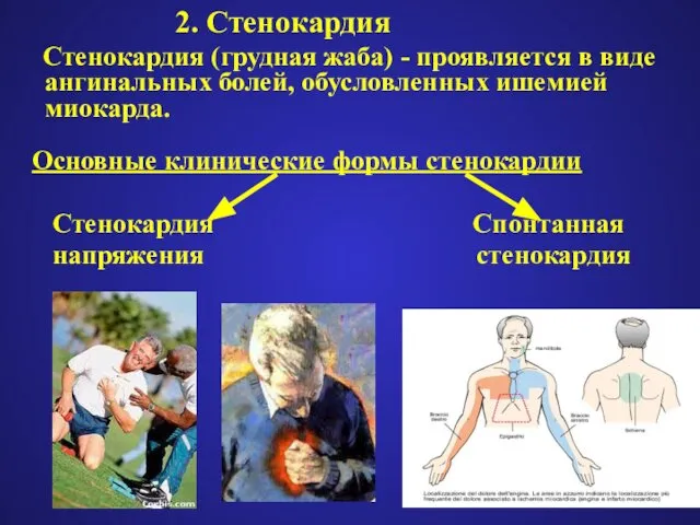 2. Стенокардия Стенокардия (грудная жаба) - проявляется в виде ангинальных болей,