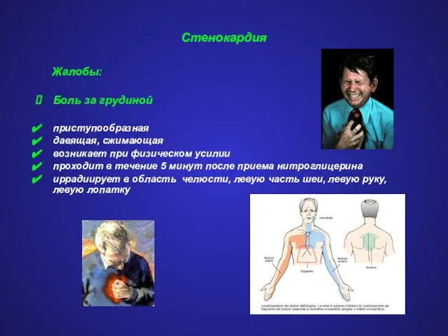 Стенокардия Жалобы: Боль за грудиной приступообразная давящая, сжимающая возникает при физическом