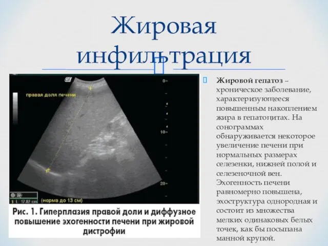 Жиpовой гепатоз – хроническое заболевание, характеризующееся повышенным накоплением жира в гепатоцитах.