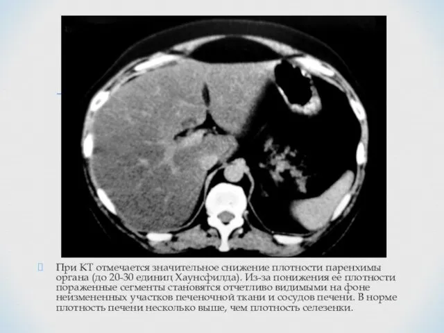 При КТ отмечается значительное снижение плотности паренхимы органа (до 20-30 единиц