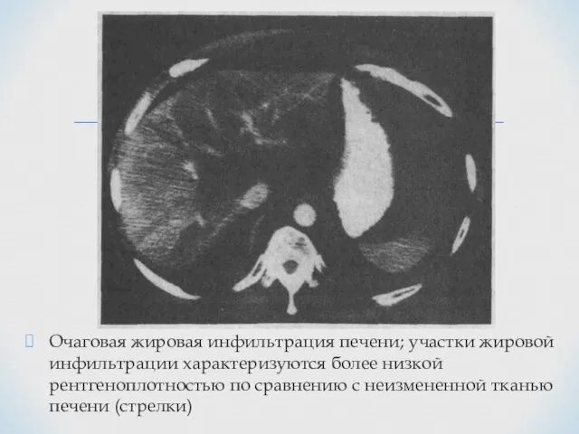 Очаговая жировая инфильтрация печени; участки жировой инфильтрации характеризуются более низкой рентгеноплотностью
