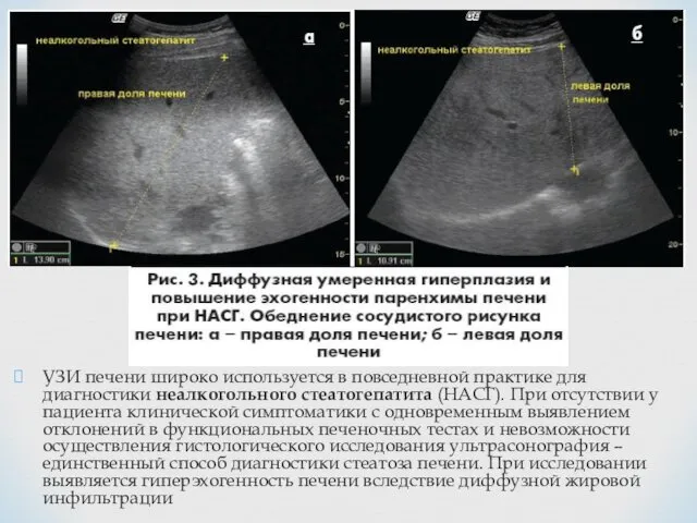 УЗИ печени широко используется в повседневной практике для диагностики неалкогольного стеатогепатита