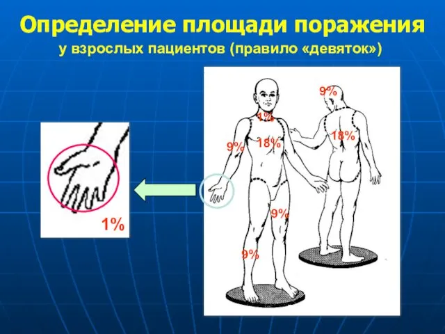 9% 9% 9% 18% 18% 9% 1% Определение площади поражения 1% у взрослых пациентов (правило «девяток»)