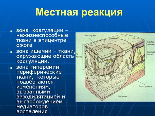 Местная реакция зона коагуляции – нежизнеспособные ткани в эпицентре ожога зона