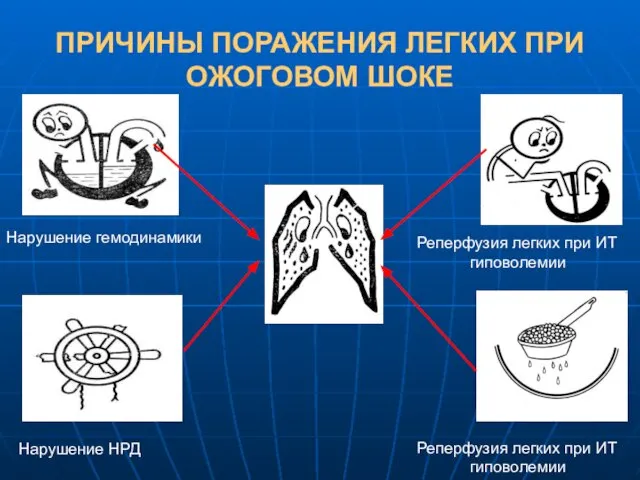 ПРИЧИНЫ ПОРАЖЕНИЯ ЛЕГКИХ ПРИ ОЖОГОВОМ ШОКЕ Нарушение гемодинамики Нарушение НРД Реперфузия