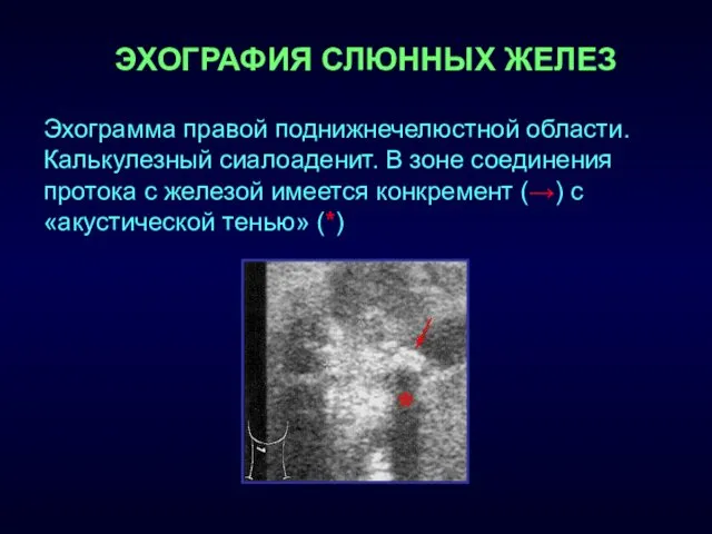 ЭХОГРАФИЯ СЛЮННЫХ ЖЕЛЕЗ Эхограмма правой поднижнечелюстной области. Калькулезный сиалоаденит. В зоне