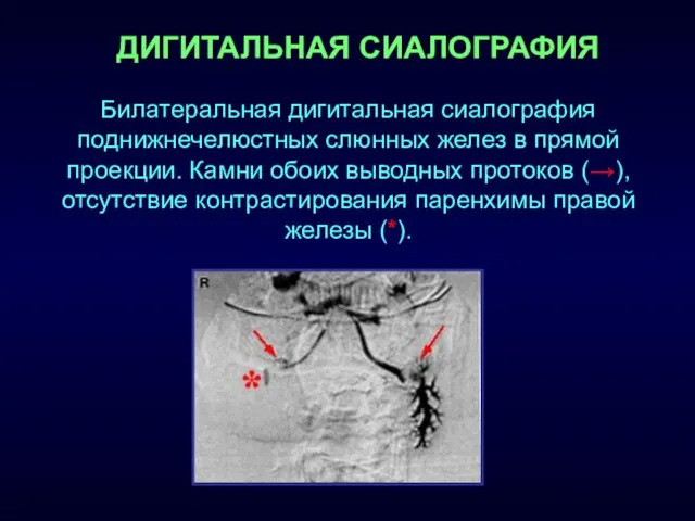 ДИГИТАЛЬНАЯ СИАЛОГРАФИЯ Билатеральная дигитальная сиалография поднижнечелюстных слюнных желез в прямой проекции.