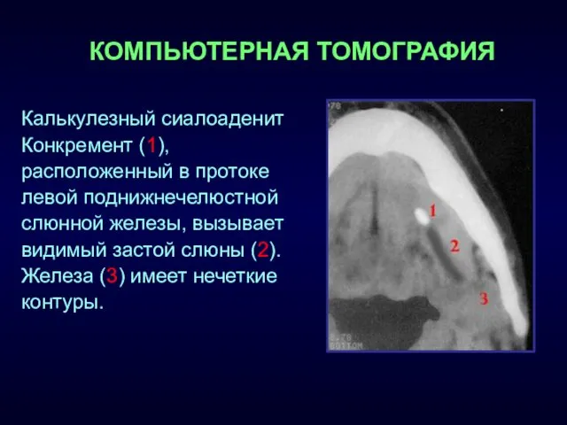 КОМПЬЮТЕРНАЯ ТОМОГРАФИЯ Калькулезный сиалоаденит Конкремент (1), расположенный в протоке левой поднижнечелюстной