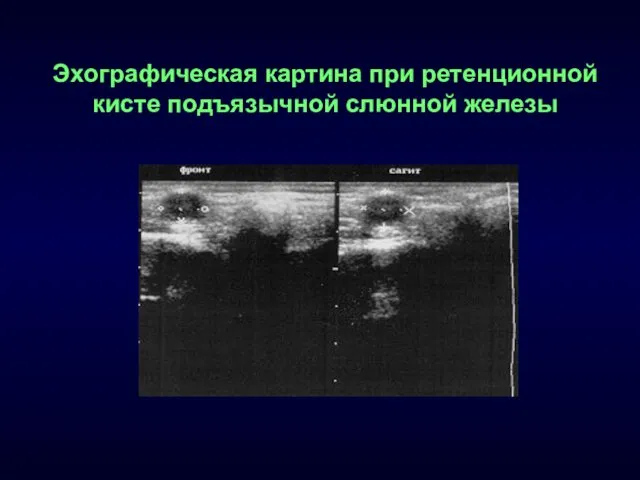 Эхографическая картина при ретенционной кисте подъязычной слюнной железы