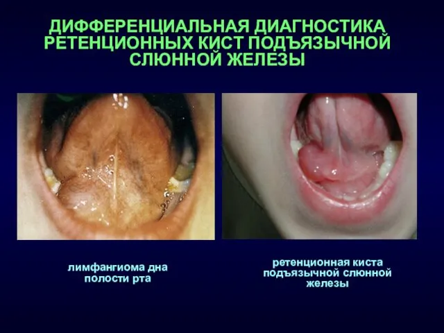 ДИФФЕРЕНЦИАЛЬНАЯ ДИАГНОСТИКА РЕТЕНЦИОННЫХ КИСТ ПОДЪЯЗЫЧНОЙ СЛЮННОЙ ЖЕЛЕЗЫ лимфангиома дна полости рта ретенционная киста подъязычной слюнной железы