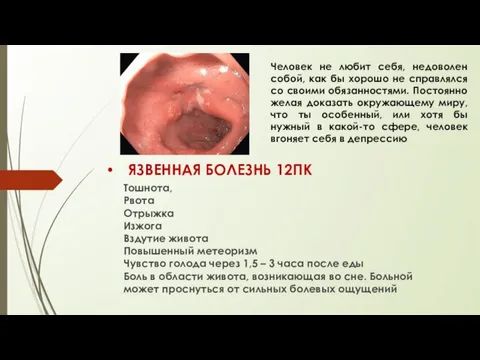 ЯЗВЕННАЯ БОЛЕЗНЬ 12ПК Тошнота, Рвота Отрыжка Изжога Вздутие живота Повышенный метеоризм