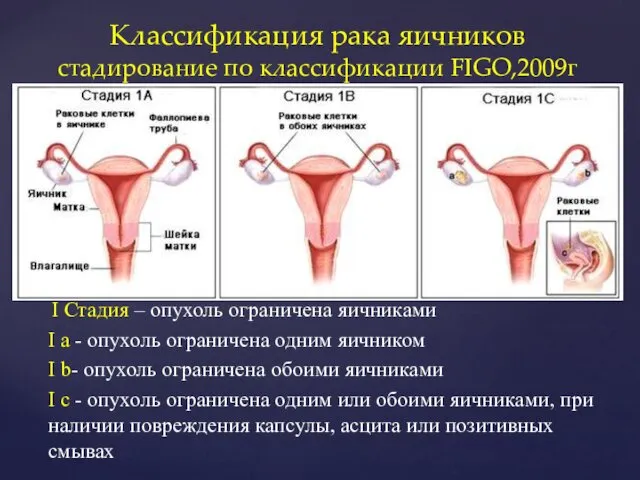 I Стадия – опухоль ограничена яичниками I a - опухоль ограничена