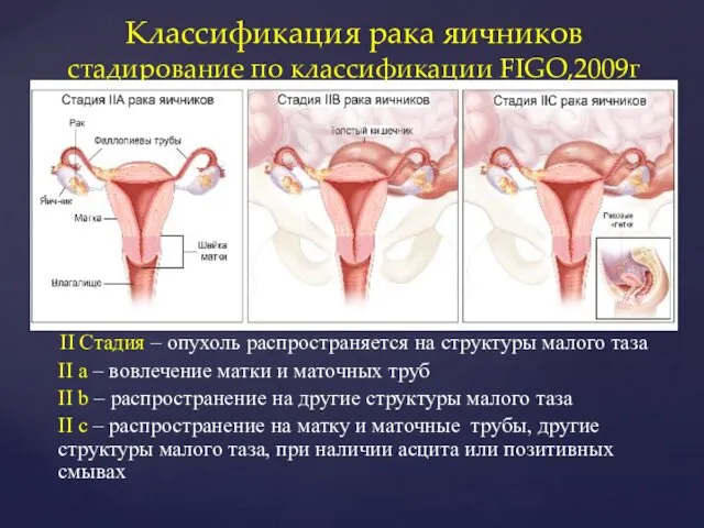 II Стадия – опухоль распространяется на структуры малого таза II a