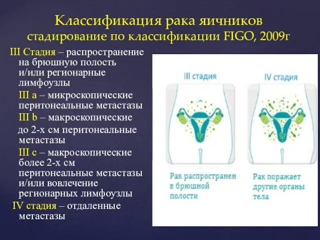 III Стадия – распространение на брюшную полость и/или регионарные лимфоузлы III