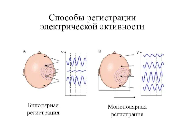 Способы регистрации электрической активности Биполярная регистрация Монополярная регистрация