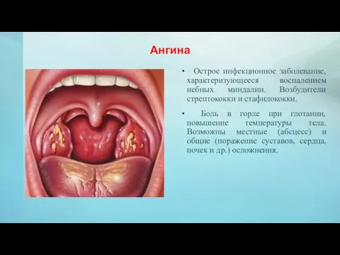 Ангина Острое инфекционное заболевание, характеризующееся воспалением небных миндалин. Возбудители стрептококки и