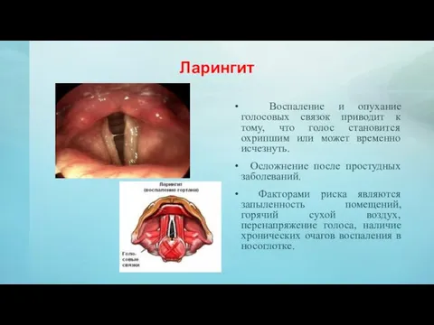 Ларингит Воспаление и опухание голосовых связок приводит к тому, что голос