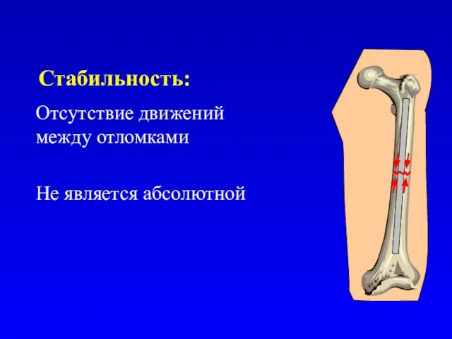 Стабильность: Отсутствие движений между отломками Не является абсолютной