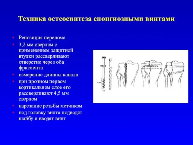 Техника остеосинтеза спонгиозными винтами Репозиция перелома 3,2 мм сверлом с применением