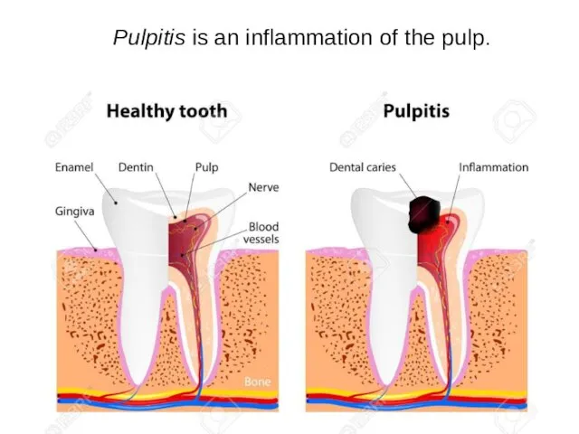 Pulpitis is an inflammation of the pulp.