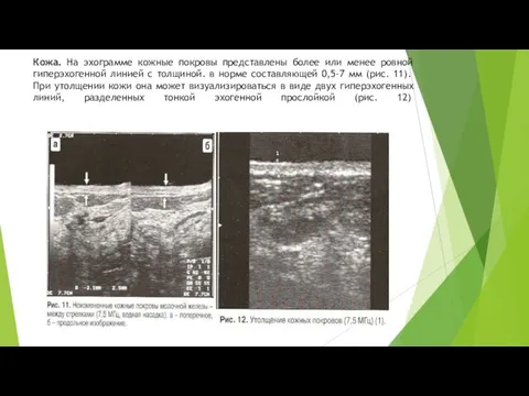 Кожа. На эхограмме кожные покровы представлены более или менее ровной гиперэхогенной