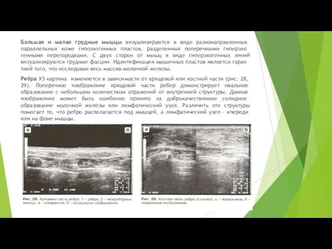 Большая и малая грудные мышцы визуализируют­ся в виде разнонаправленных параллельных коже