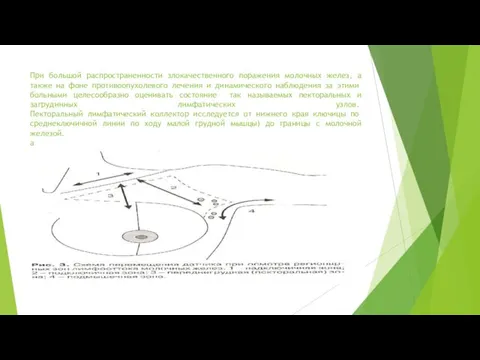 При большой распространенности злокачественного поражения молочных желез, а также на фоне