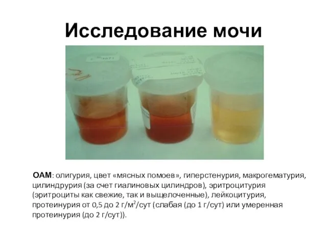 Исследование мочи ОАМ: олигурия, цвет «мясных помоев», гиперстенурия, макрогематурия, цилиндрурия (за