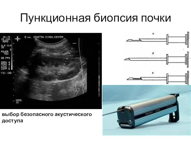 Пункционная биопсия почки выбор безопасного акустического доступа