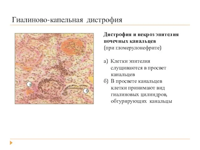 Гиалиново-капельная дистрофия Дистрофия и некроз эпителия почечных канальцев (при гломерулонефрите) а)