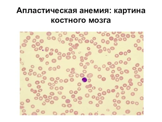 Апластическая анемия: картина костного мозга