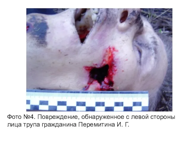 Фото №4. Повреждение, обнаруженное с левой стороны лица трупа гражданина Перемитина И. Г.