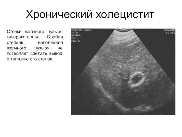 Хронический холецистит Стенки желчного пузыря гиперэхогенны. Слабая степень наполнения желчного пузыря