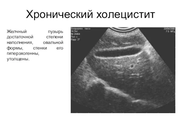 Хронический холецистит Желчный пузырь достаточной степени наполнения, овальной формы, стенки его гиперэхогенны, утолщены.