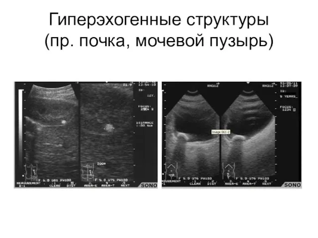 Гиперэхогенные структуры (пр. почка, мочевой пузырь)