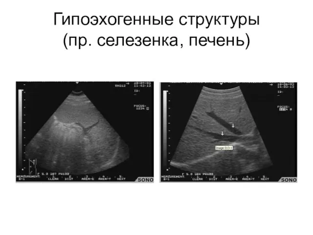 Гипоэхогенные структуры (пр. селезенка, печень)