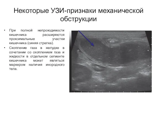 Некоторые УЗИ-признаки механической обструкции При полной непроходимости кишечника расширяются проксимальные участки